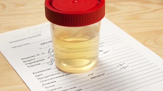 Urine -analyse voor arteriële hypertensie